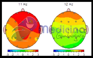 Mapeo Cerebral en Guadalajara Jalisco Mexico