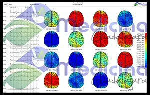 Video Mapeo Cerebral en Guadalajara Jalisco Mexico
