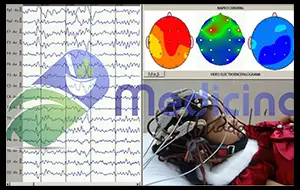 Video Electroencefalograma y Video Mapeo Cerebral en Guadalajara Jalisco Mexico